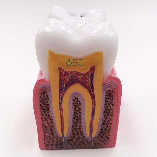 thumbnail image 2 of Dental Vitro Teeth Decay Caries Tooth Model #36 For Student Practice - Fits Nissin ADC 2 of 4